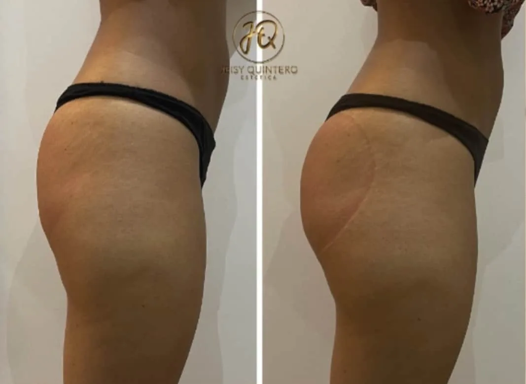 Antes y después centro estética Jeisy Quintero