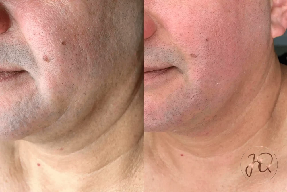 Antes y después de radiofrecuencia Venus Legacy facial en Jeisy Quintero — mejoría de textura y tono de piel