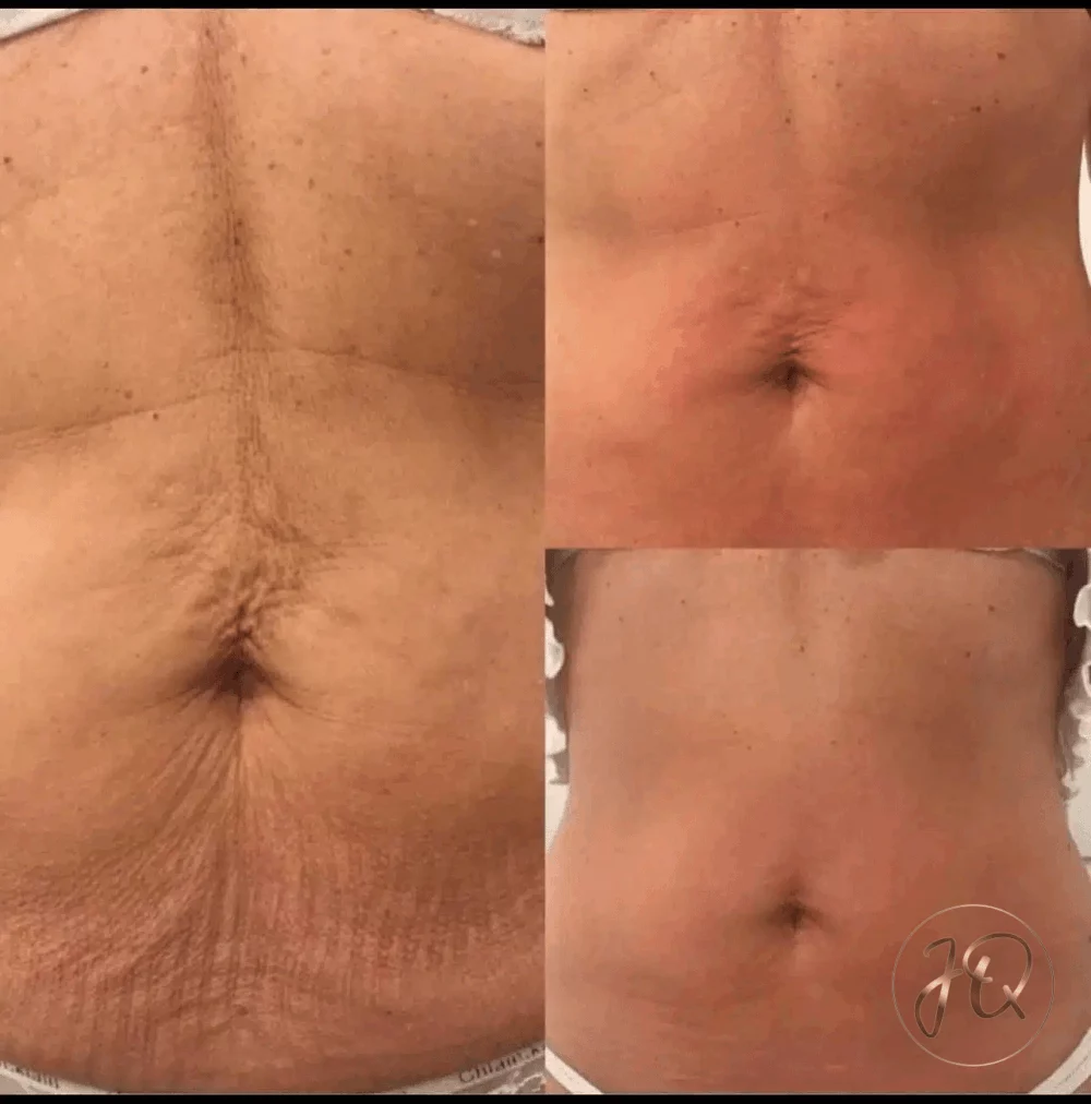 Antes y después de radiofrecuencia Venus Legacy corporal en Jeisy Quintero — tonificación de piel y reducción de celulitis