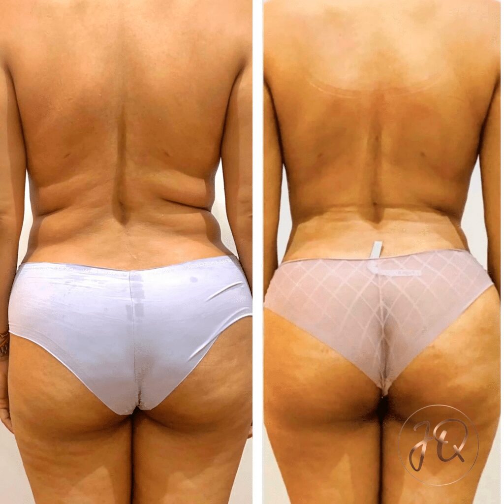 Transformación corporal con maderoterapia: antes y después