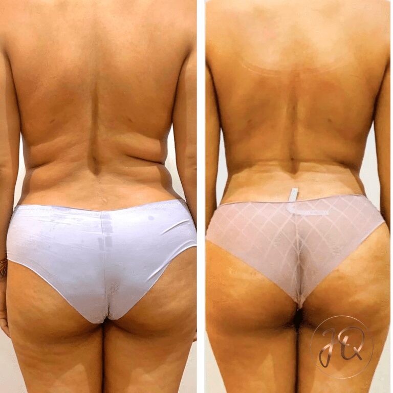 Transformación corporal con maderoterapia: antes y después