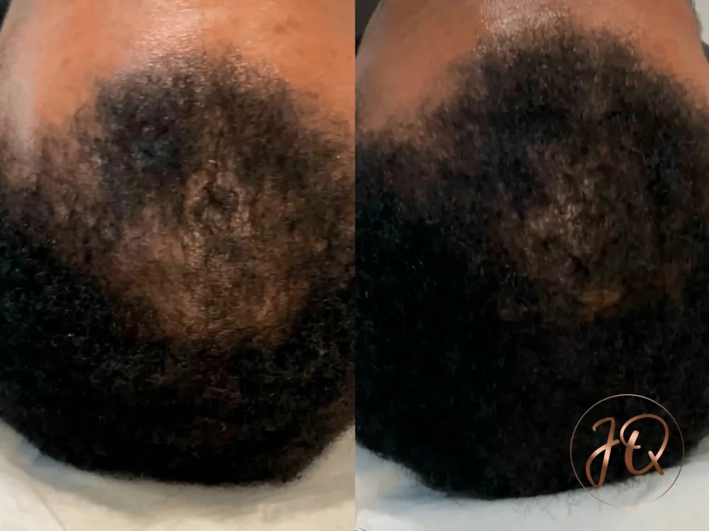 Antes y después de tratamiento Hair Growth en Jeisy Quintero — recuperación y densidad capilar