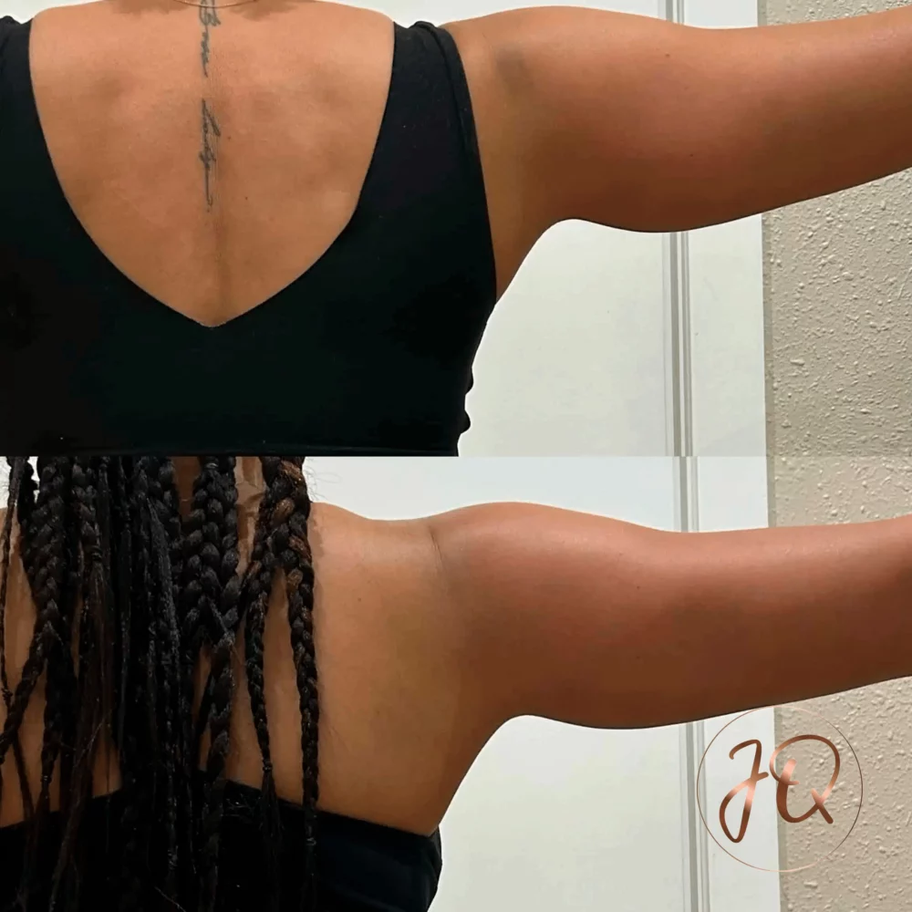 Antes y después de radiofrecuencia Venus Legacy corporal en Jeisy Quintero — modelado y reducción de medidas