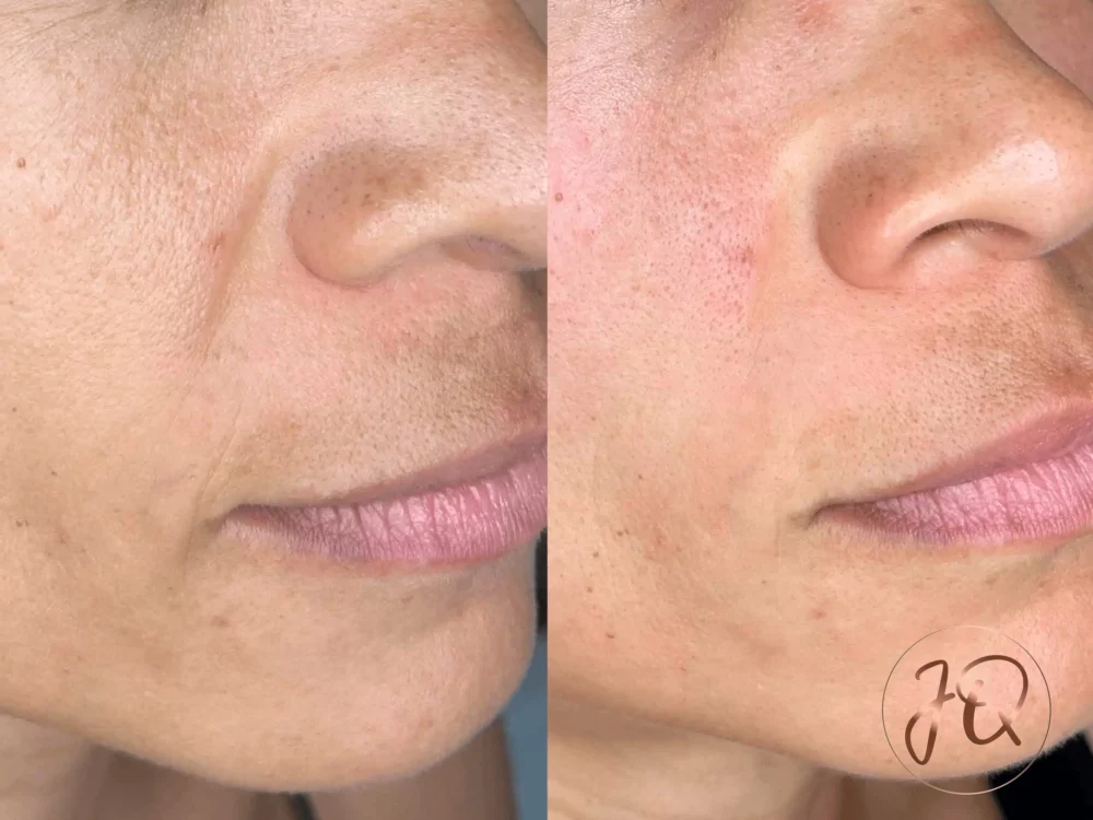 Antes y después de radiofrecuencia Venus Legacy facial en Jeisy Quintero — contorno facial y reducción de papada