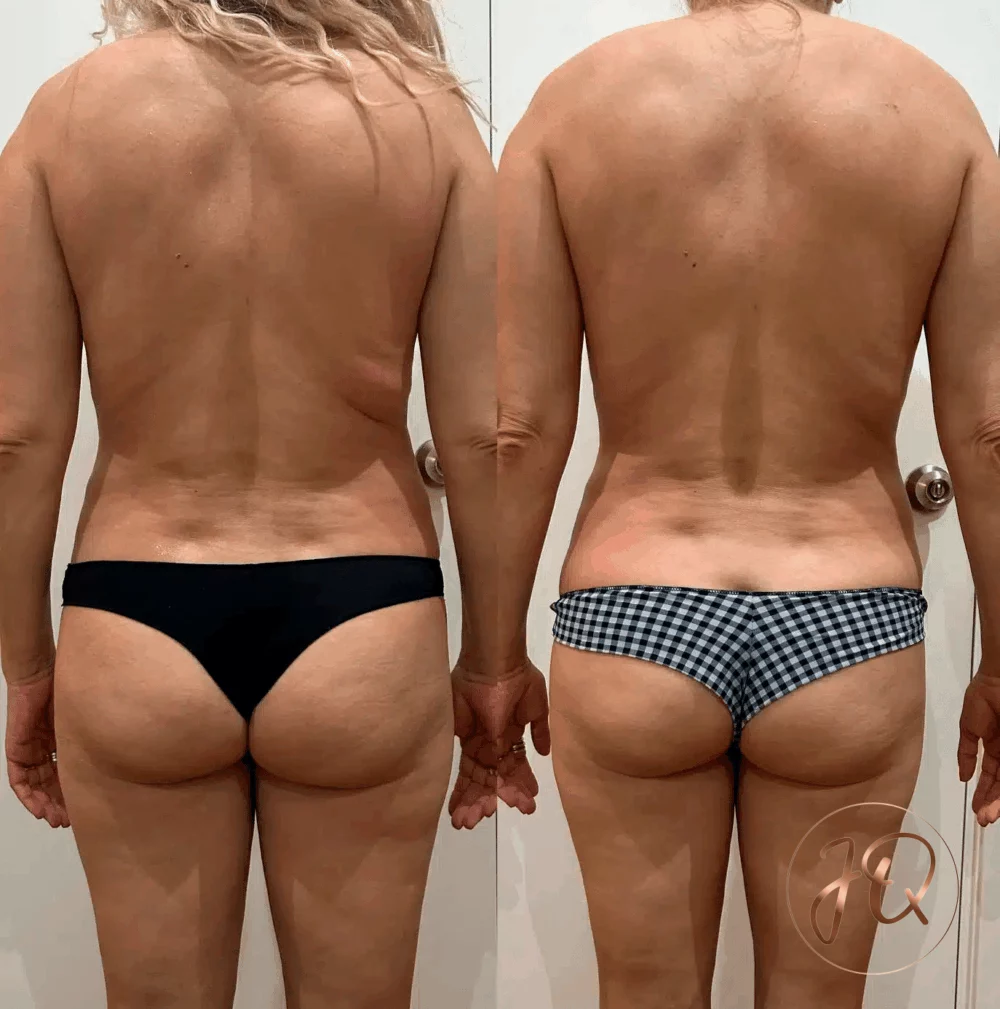 Antes y después de radiofrecuencia Venus Legacy corporal en Jeisy Quintero — piel más firme y lisa