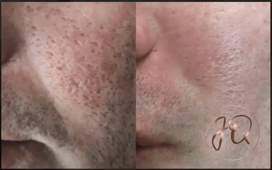 Antes y después de Dermapen en Jeisy Quintero — mejora de textura de piel y reducción de poros